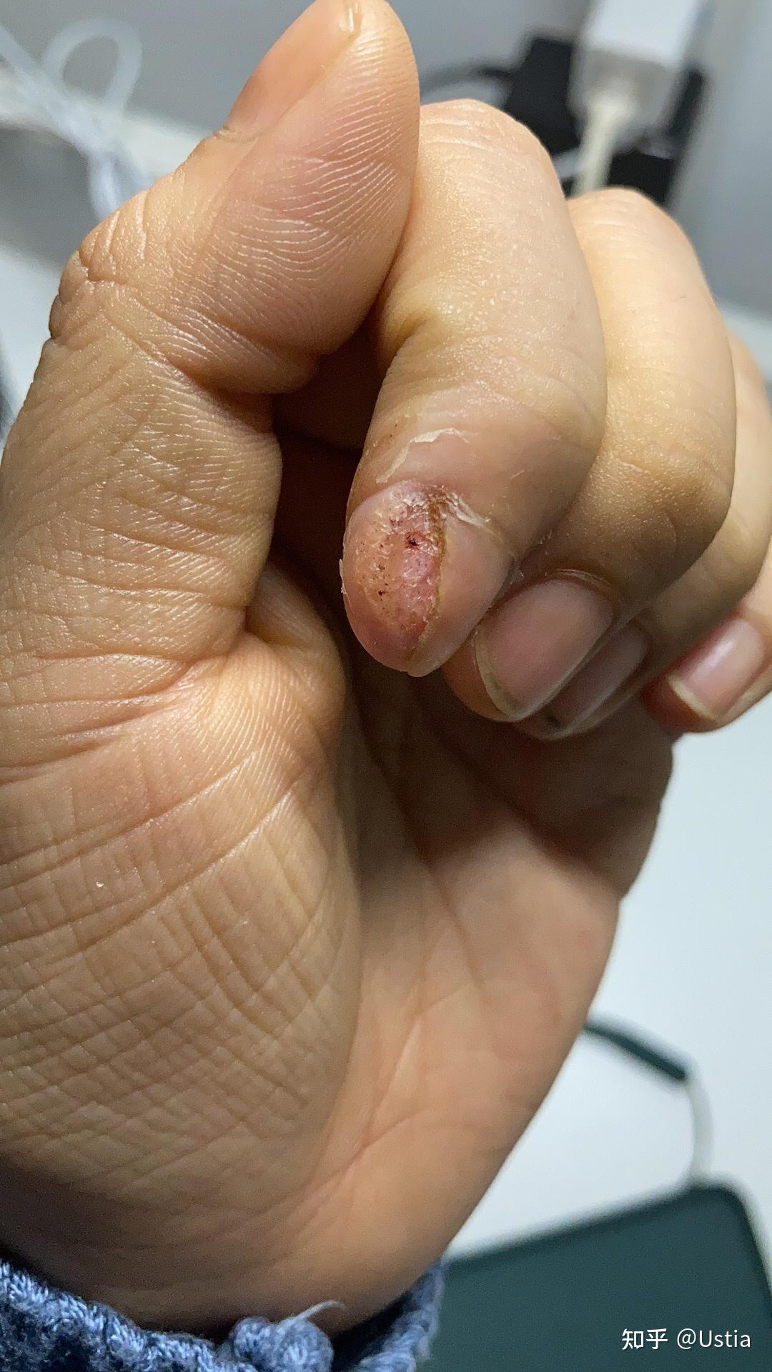 各位大神鄙人手残手指甲旁边长了死皮用指甲刀剪的时候把一些肉也剪了