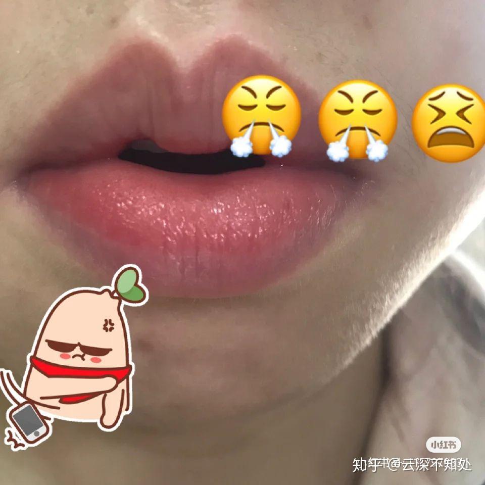 我的唇炎史 - 知乎