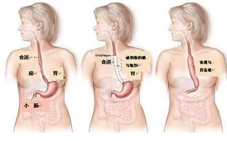 开胸手术是食管癌治疗的主要方式之一,但是进展期食管癌仅仅用单纯