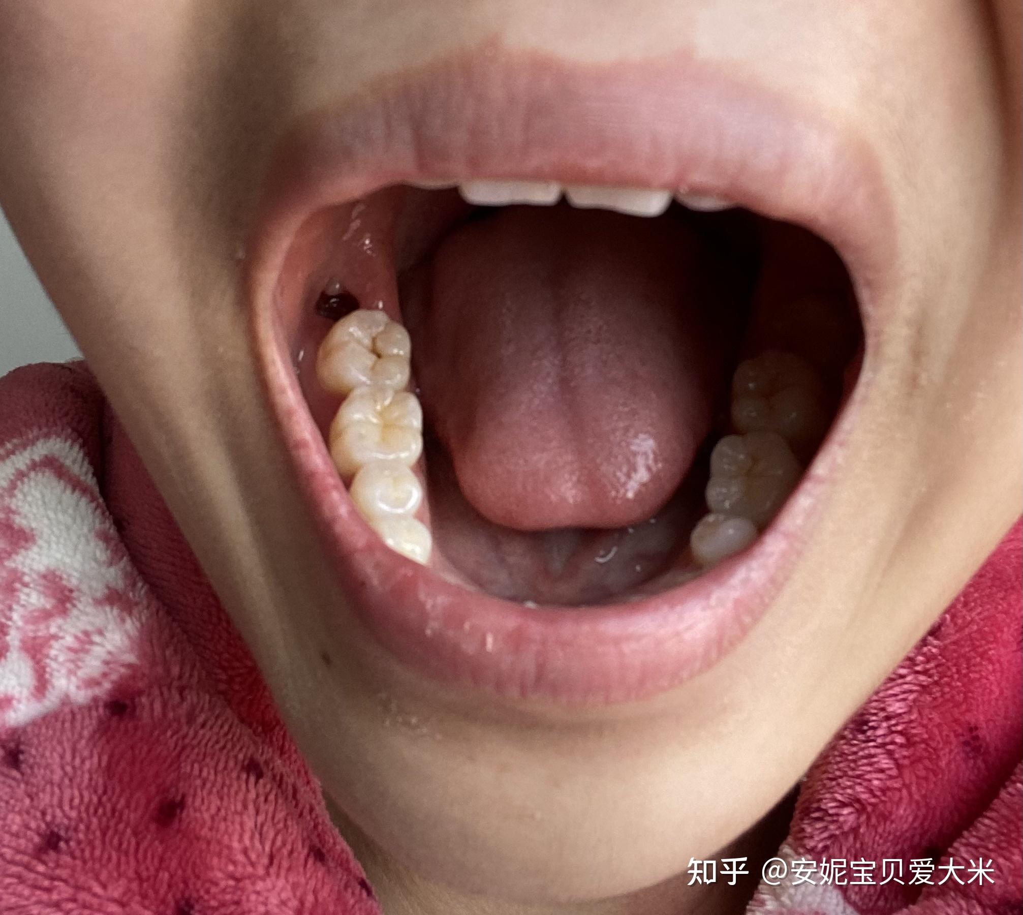 智齿是长在哪个位置的(牙齿最里面那坨肉疼怎么办)