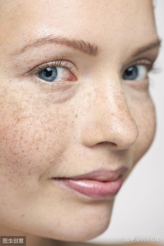 皮肤暗沉脸上长斑如何祛除专家教您9种方法2种维生素不可少