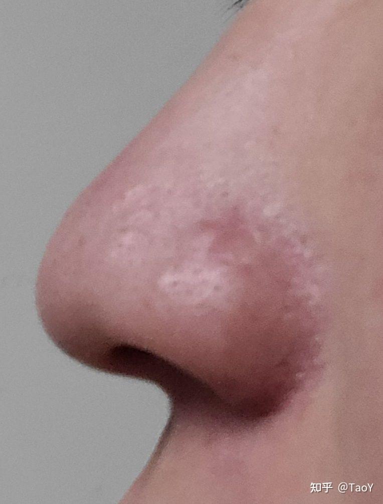 鼻子上凸起的增生痘疤怎么去除