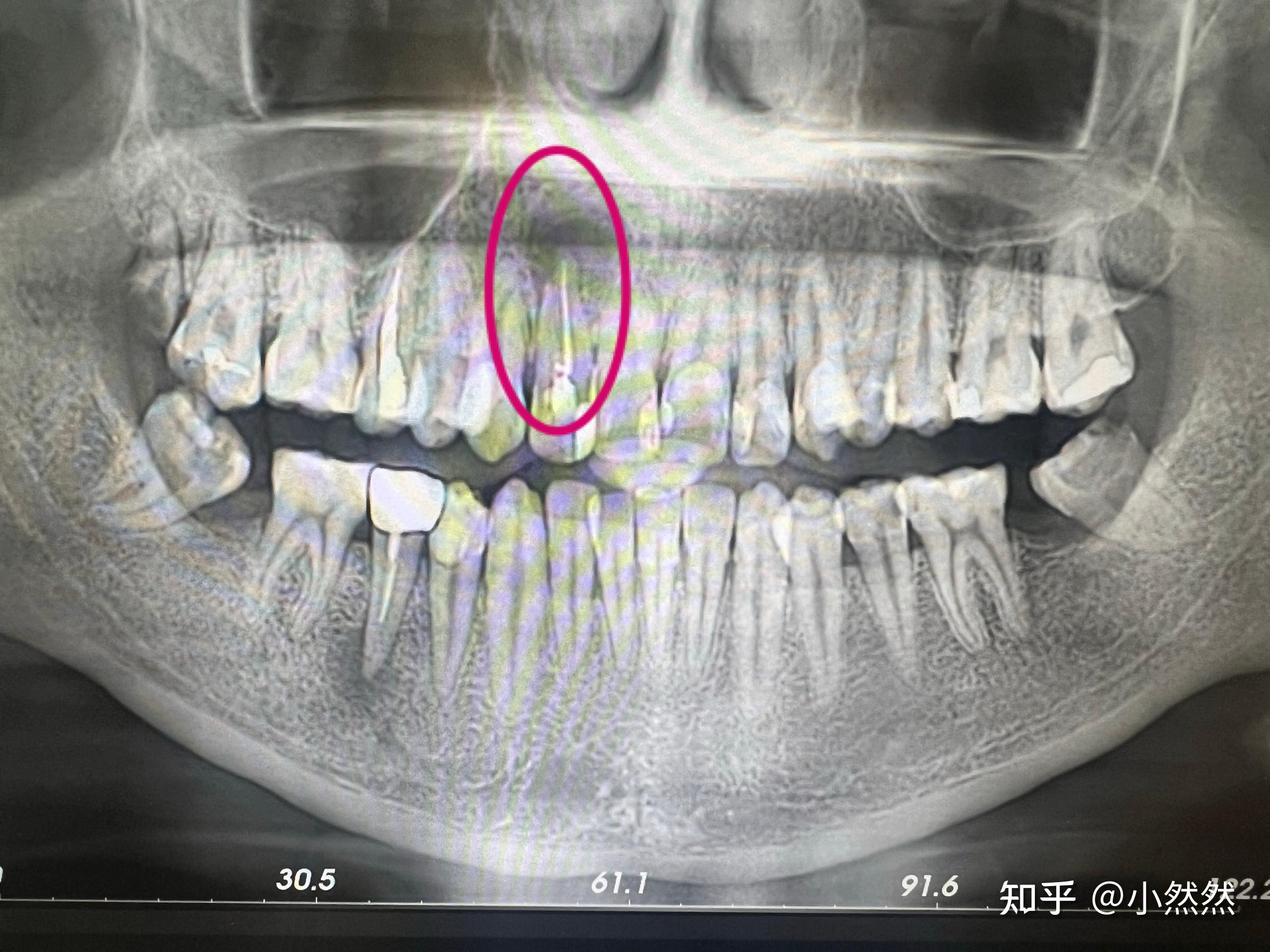 大牙牙根图片x光图图片