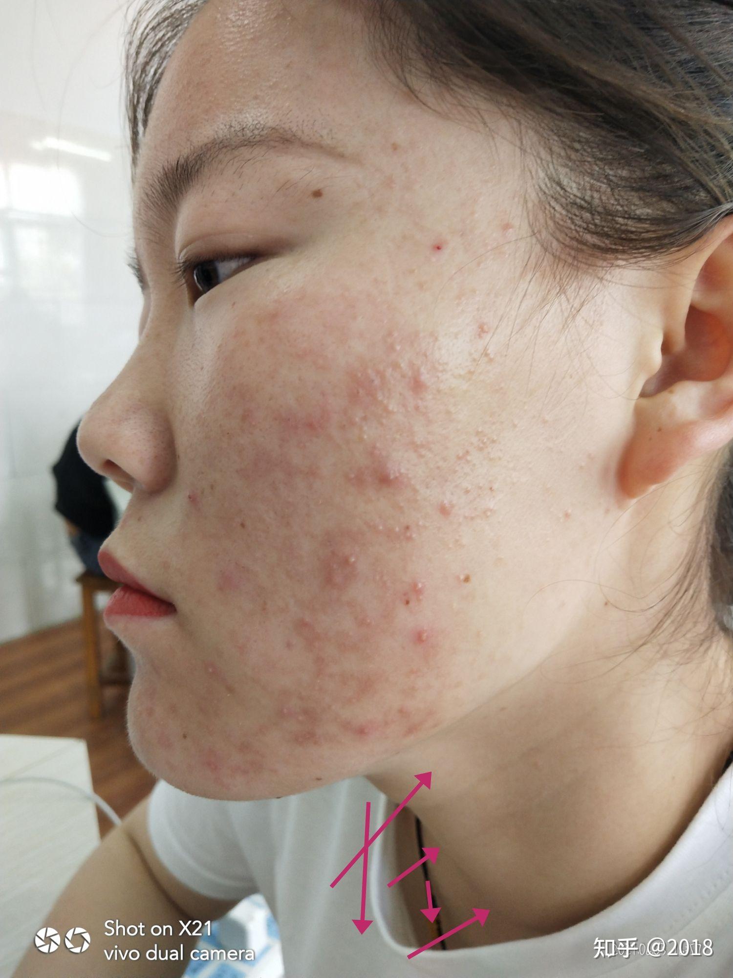 作为一个青春期的学生满脸痘痘一直苦恼着我如何轻松祛痘