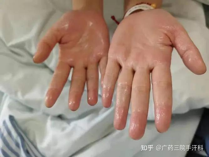 如何防止手出汗