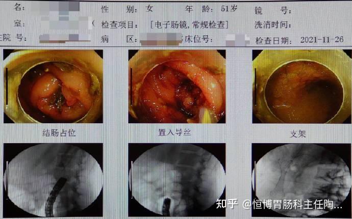 肠癌晚期照片图片