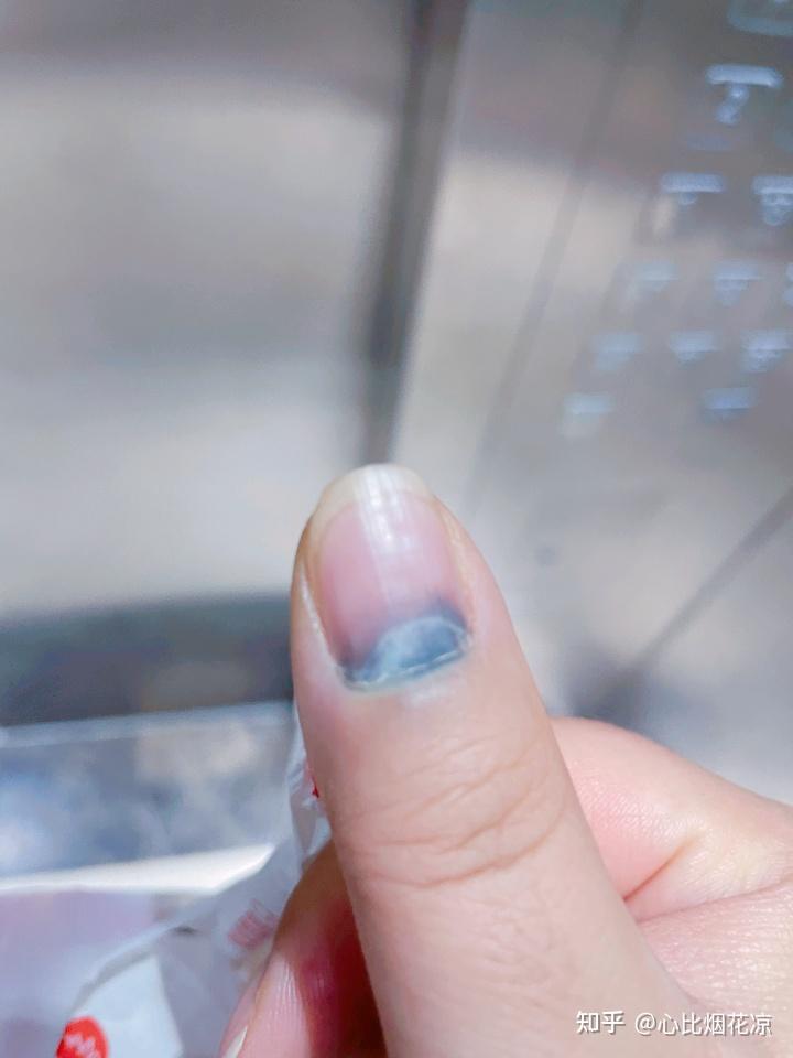 记录📝自己手指甲被夹伤的恢复过程 - 知乎