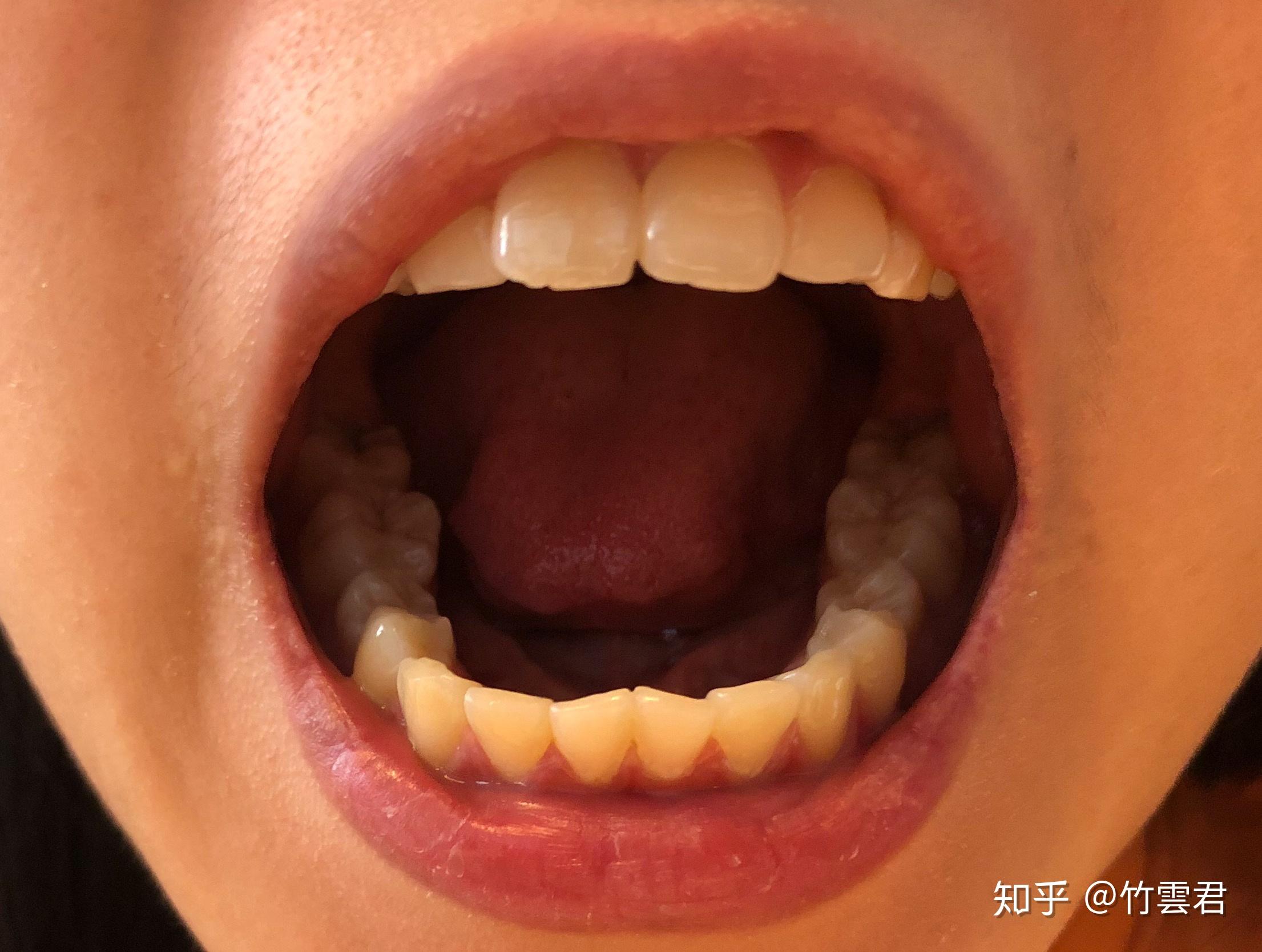 牙齿正畸全过程记录（上海徐汇牙防所） - 知乎
