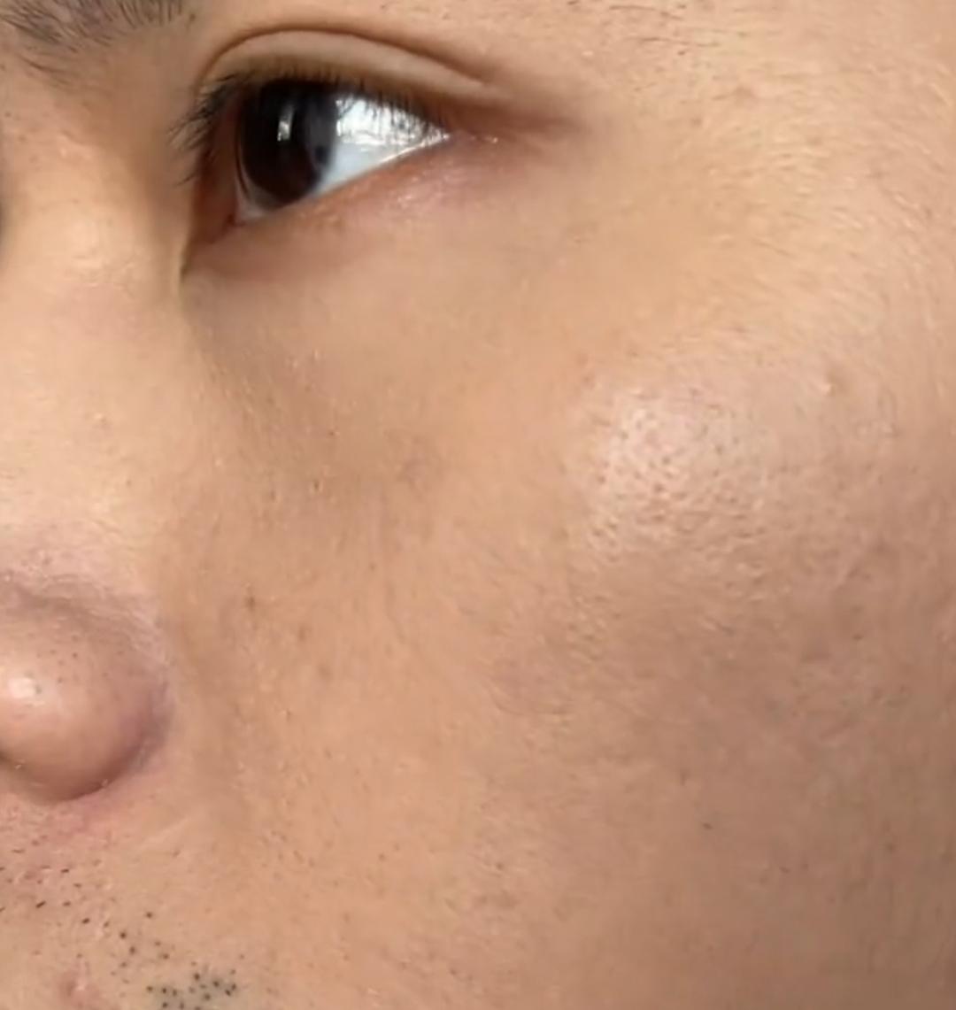 1,大毛孔真的很膈应人