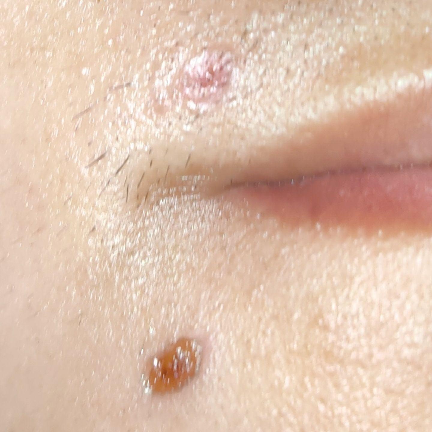 点痣 结痂 不小心把痂弄掉了,如图 ,要怎么办? - 知乎