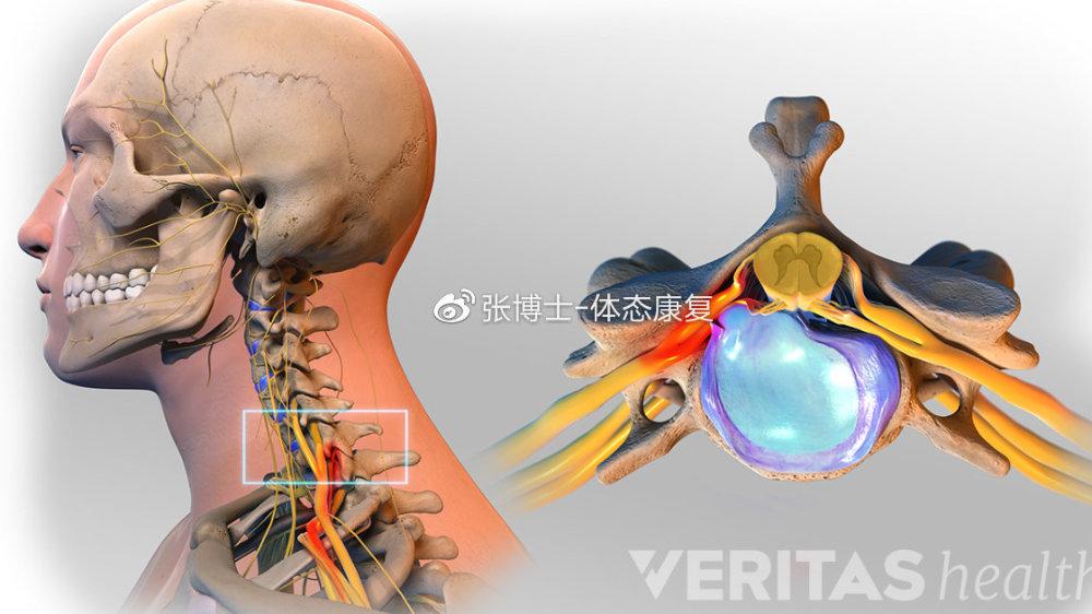 运动康复科普 颈椎间盘突出简述与康复训练 知乎