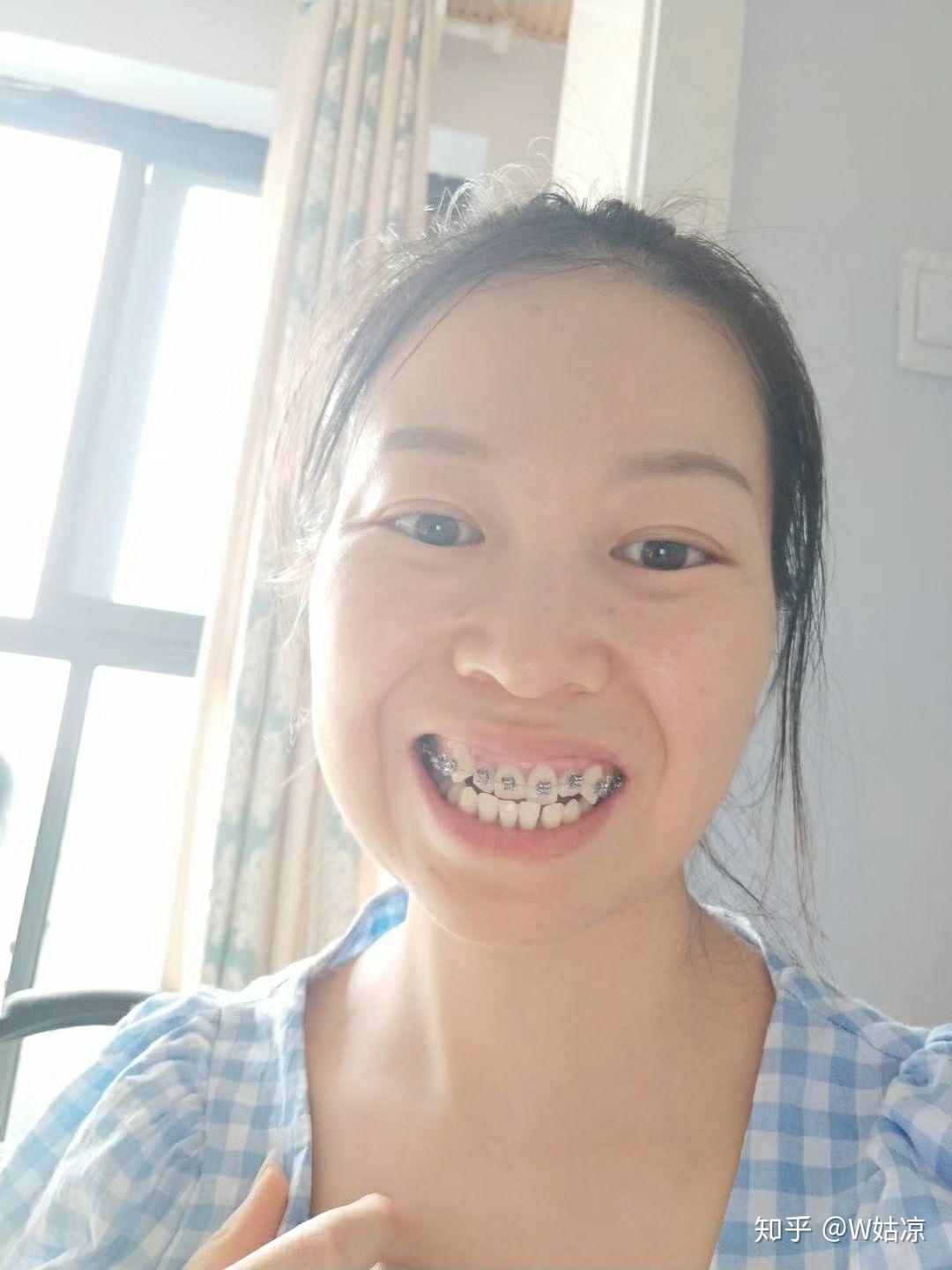 30岁高龄__骨性地包天矫正 - 知乎