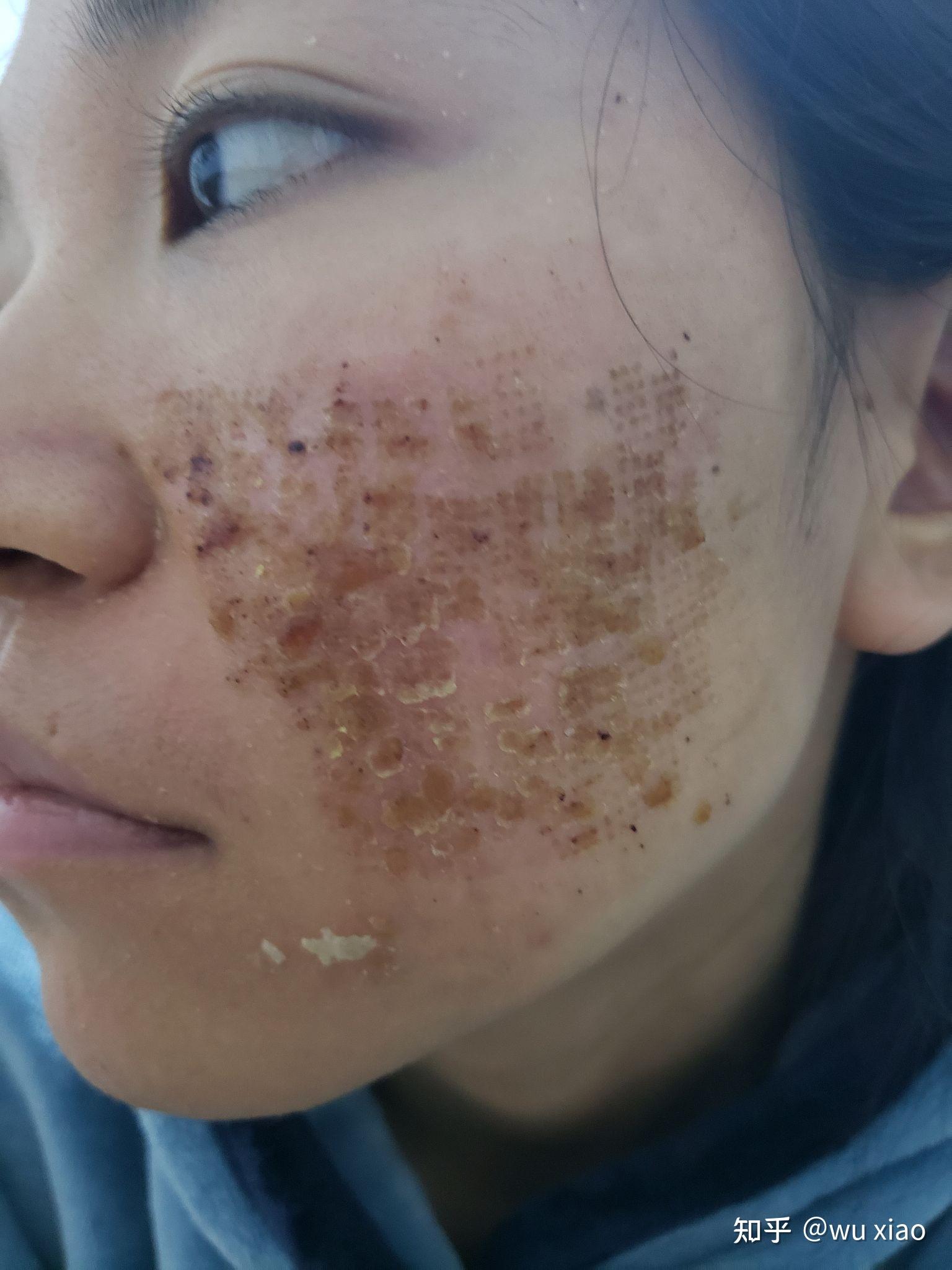 点阵激光祛痘坑是什么样的体验