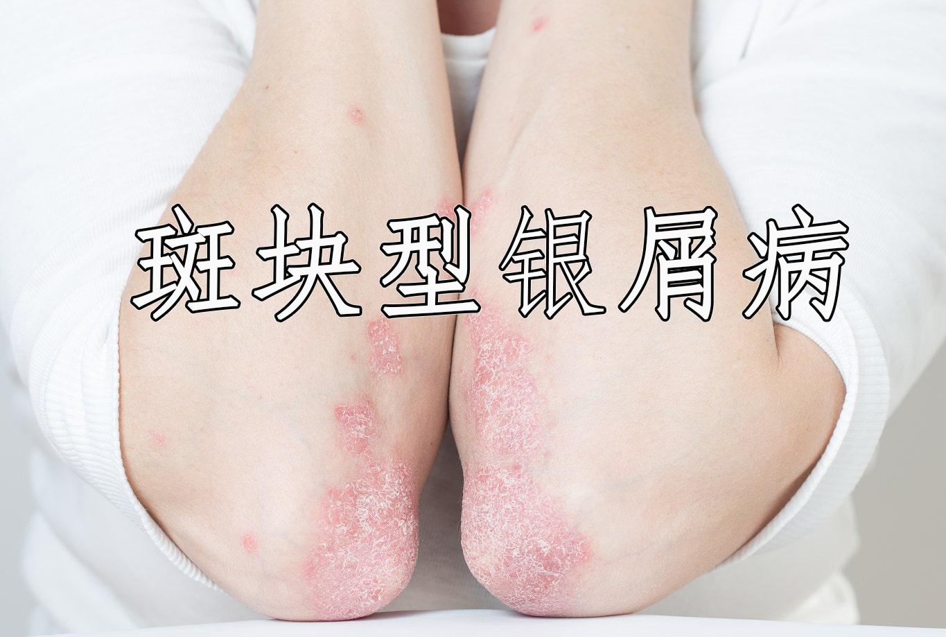 斑块型银屑病新药!fda批准无类固醇乳膏zoryve(roflumilast)0.