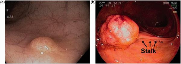 结直肠息肉与结直肠癌