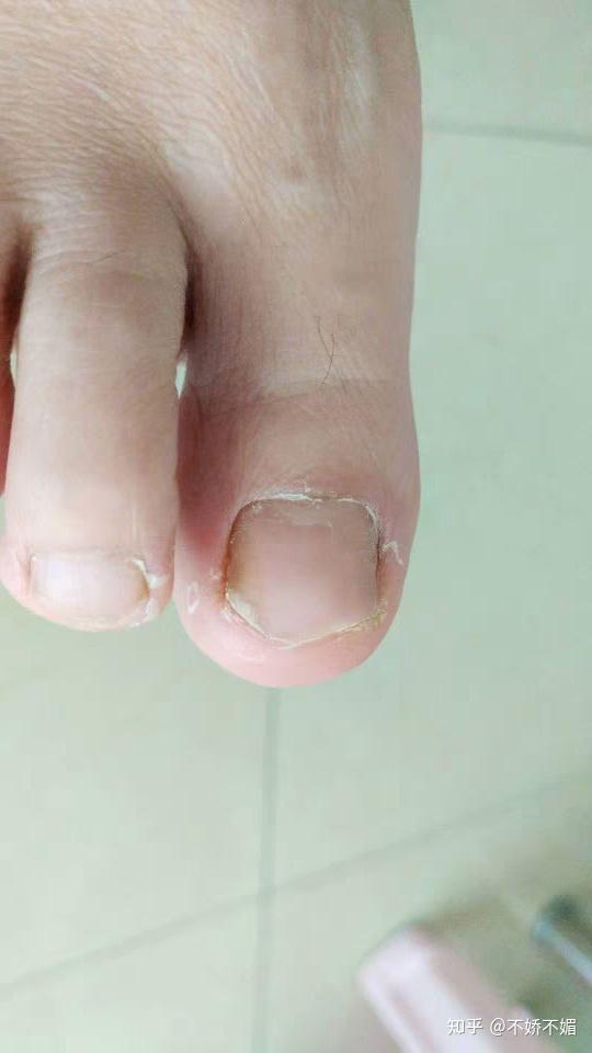 脚大拇指灰指甲初期怎么治疗,指甲盖变色发黑? - 知乎