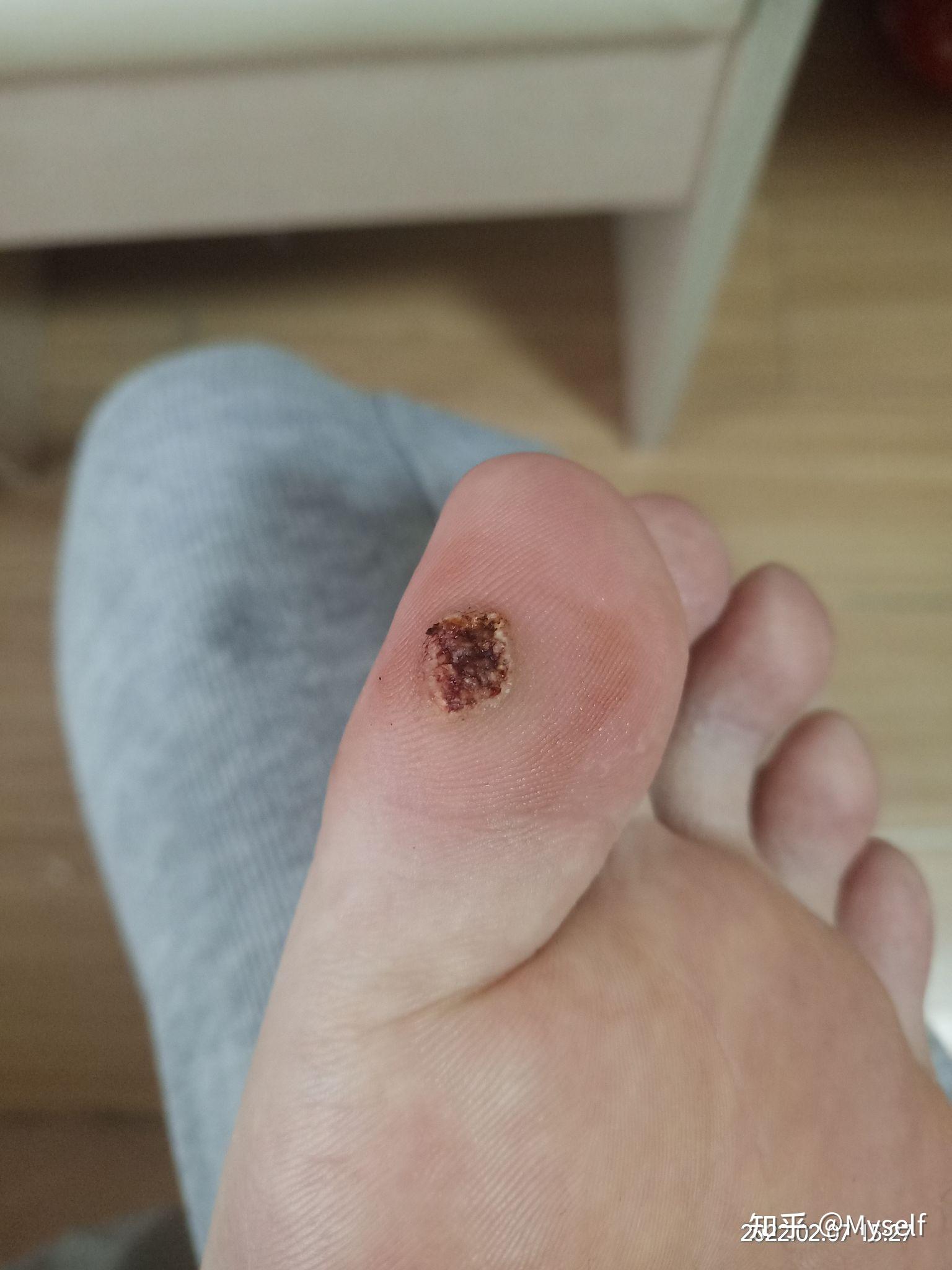 记录我的激光去疣