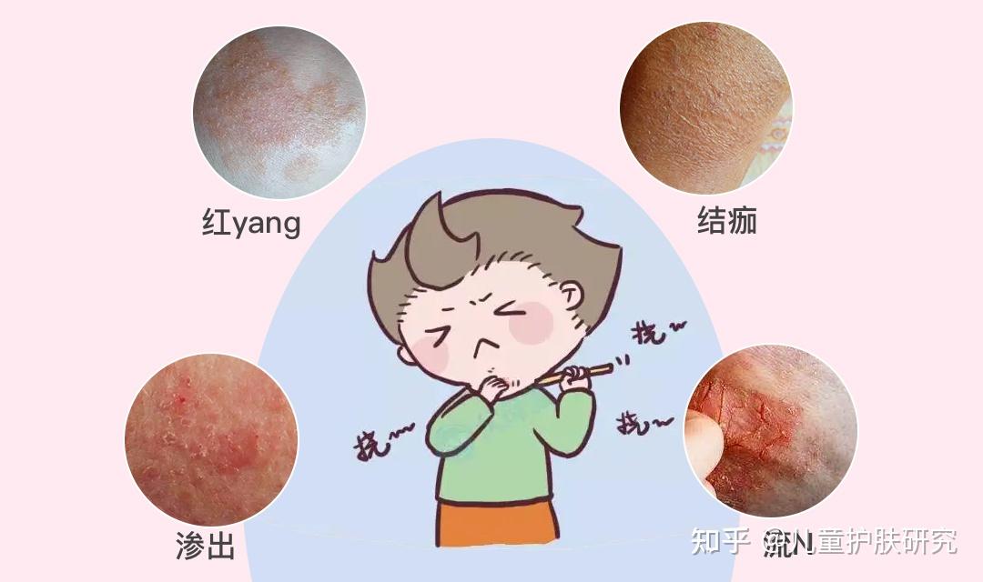 什么是特应性皮炎?和湿疹是一回事吗? - 知乎
