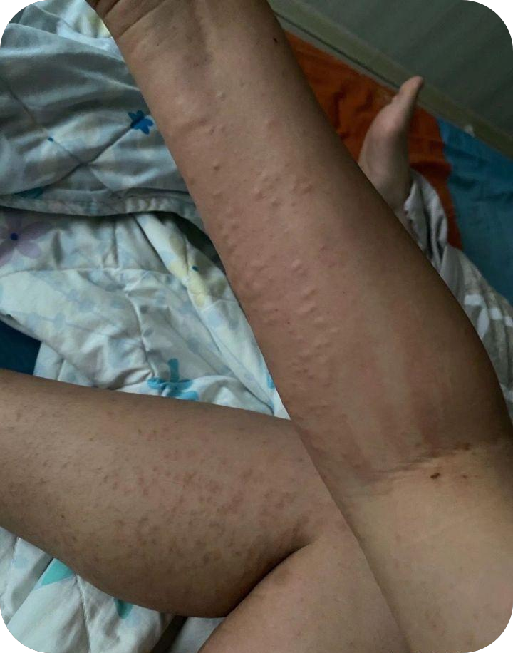 湿疹图片初期症状图片看图后做好这几点可轻松消退