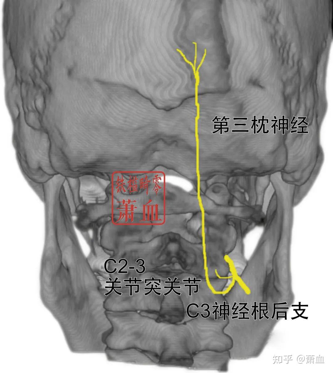 神经卡压|第三枕神经 - 知乎