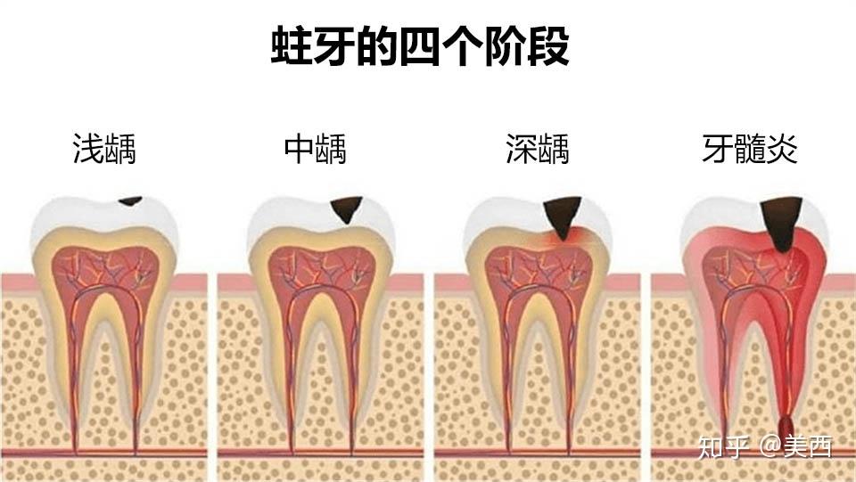 「蛀牙」产生的原因是什么,如何预防和应对? - 知乎