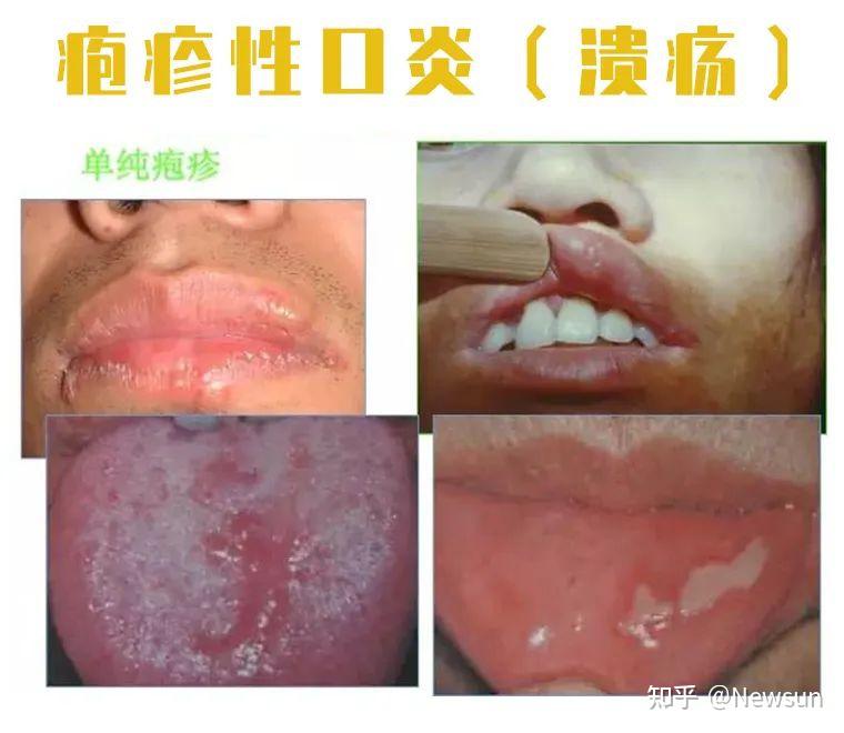 关于口腔溃疡【多图】 - 知乎