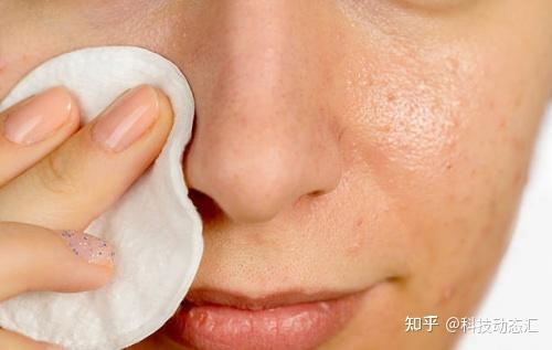 油痘皮战痘好物推荐：含足量壬二酸的美芙诺首当其冲！