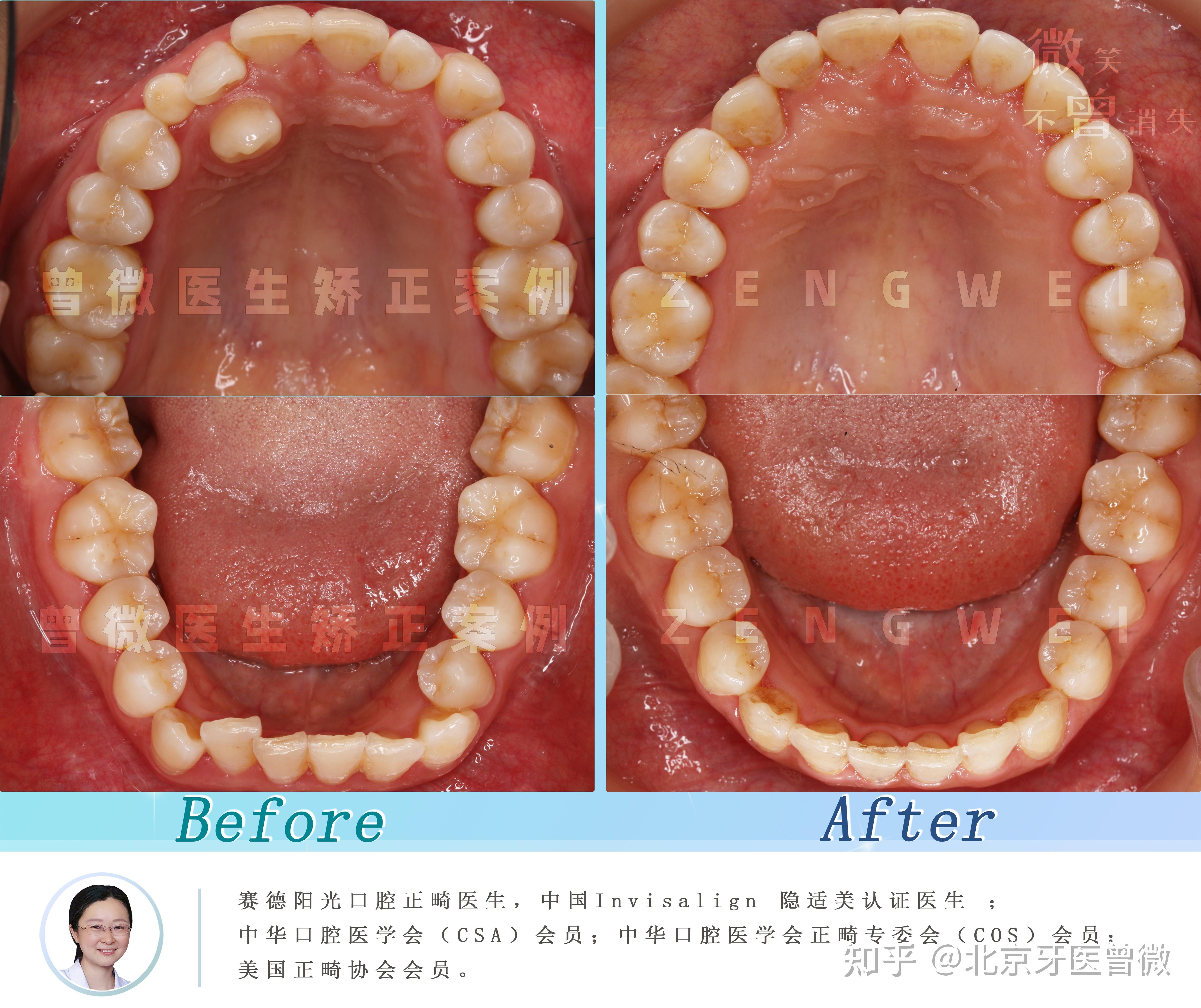 乳牙滞留导致的面型凹陷 - 知乎