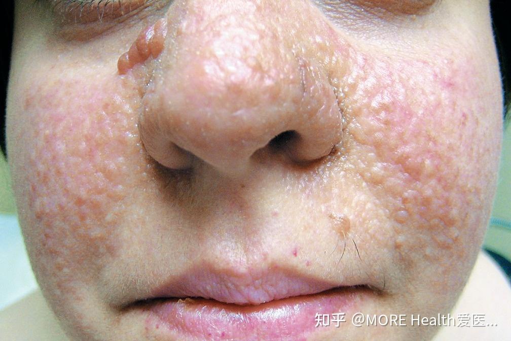 来自一位面部血管纤维瘤患者的声音