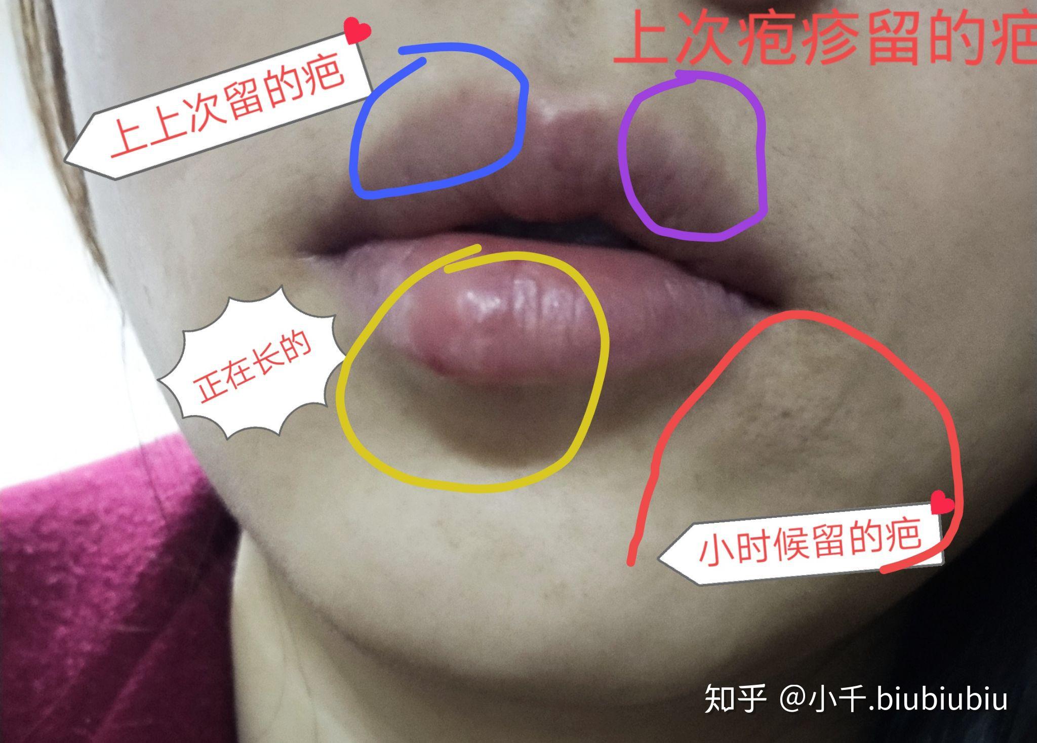 复发性单纯疱疹反复发作,长长在唇周边,十分影响美观,告诉我有什么