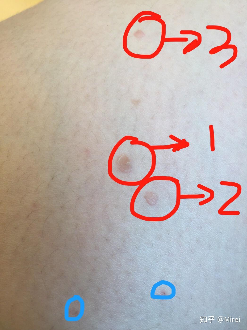 膝盖侧面长个扁扁的肉疙瘩怎么办