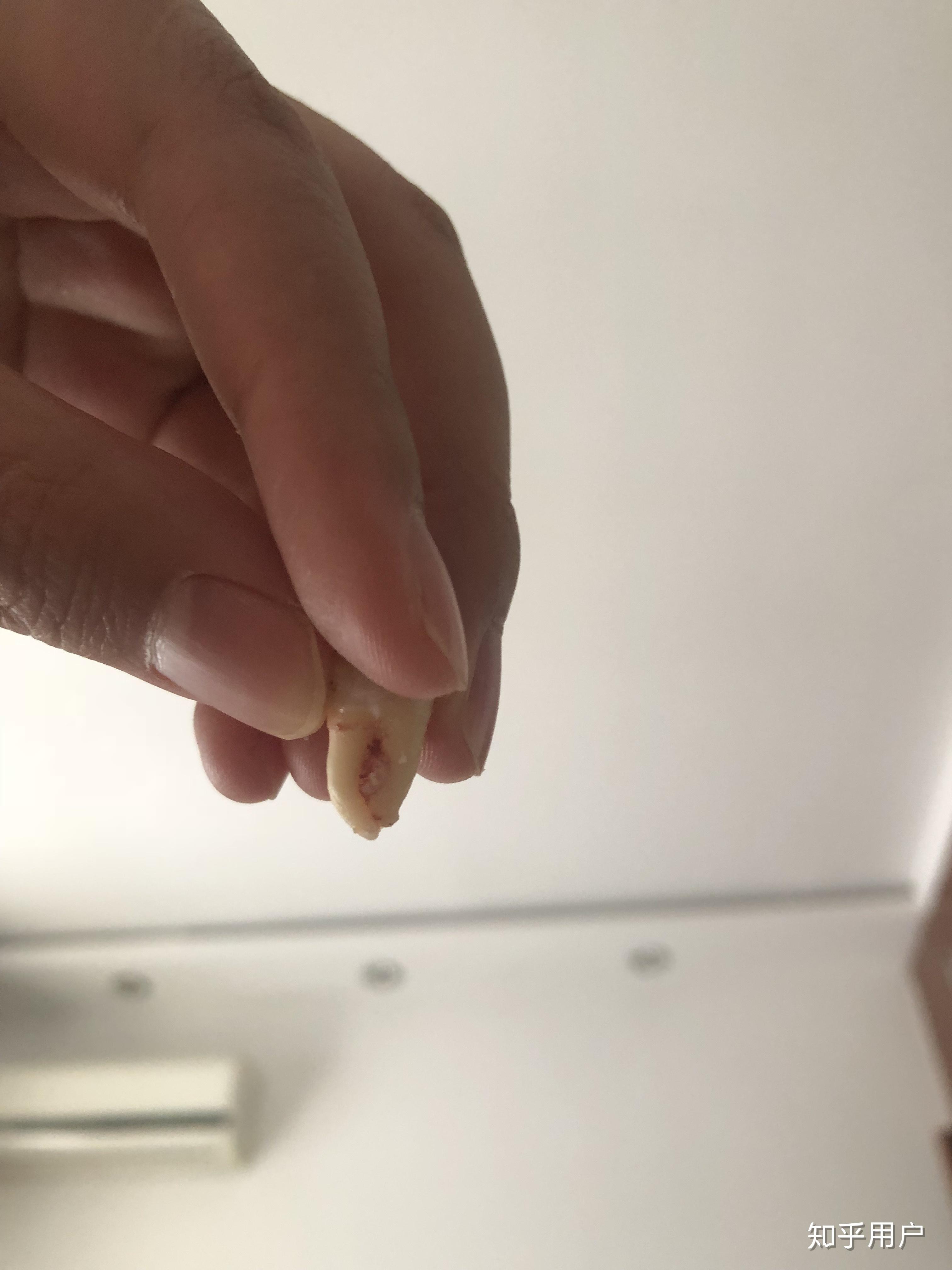 智齿牙根弯曲成鱼钩状能不能拔