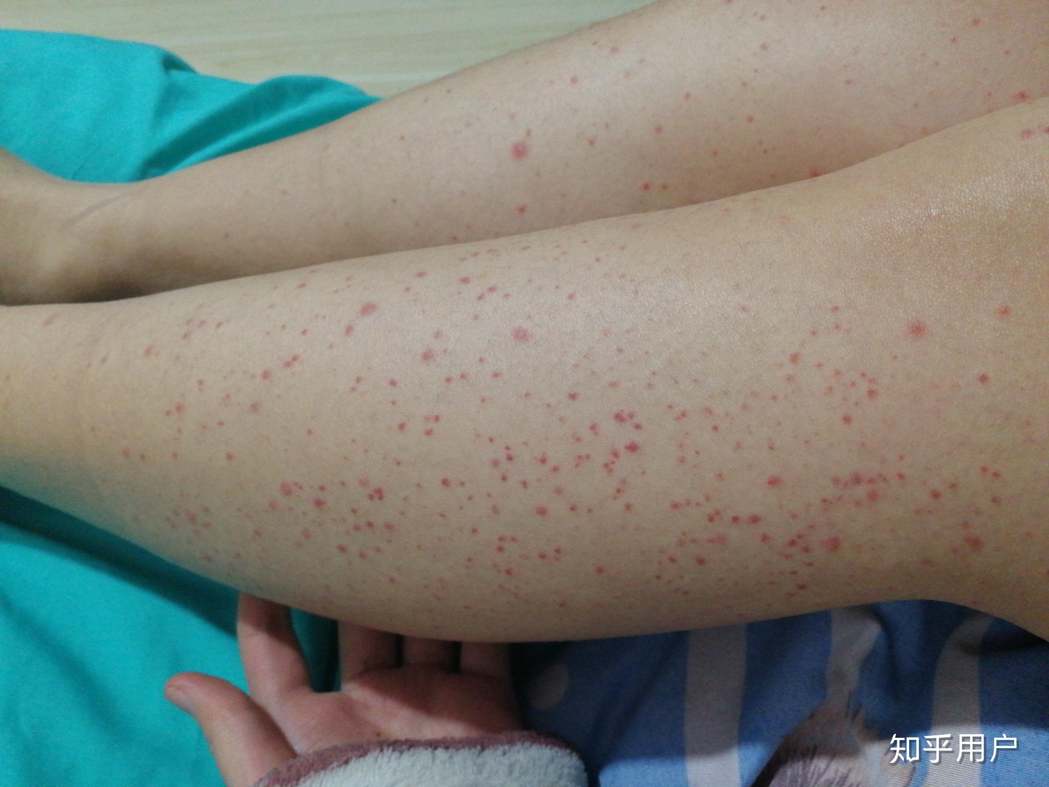 小腿有很多一点点的小红点是为什么不痛不痒