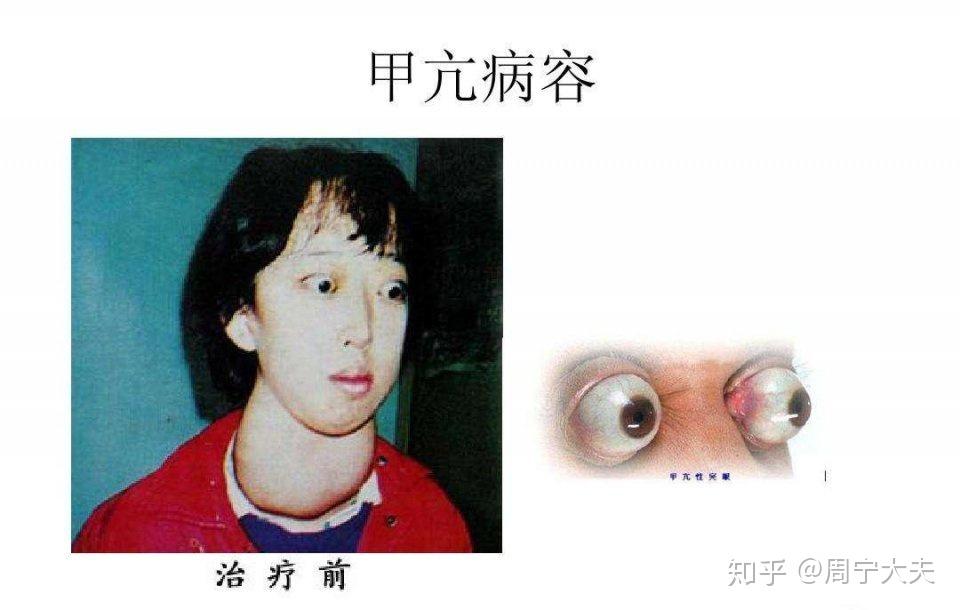 甲状腺功能亢进症简称"甲亢",是由于甲状腺功能旺盛,甲状腺激素分泌过