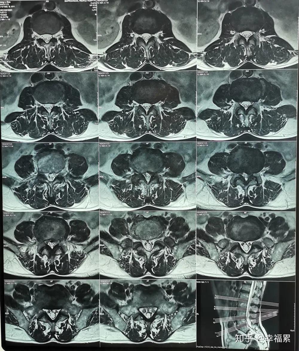 椎管狭窄影像学图片图片