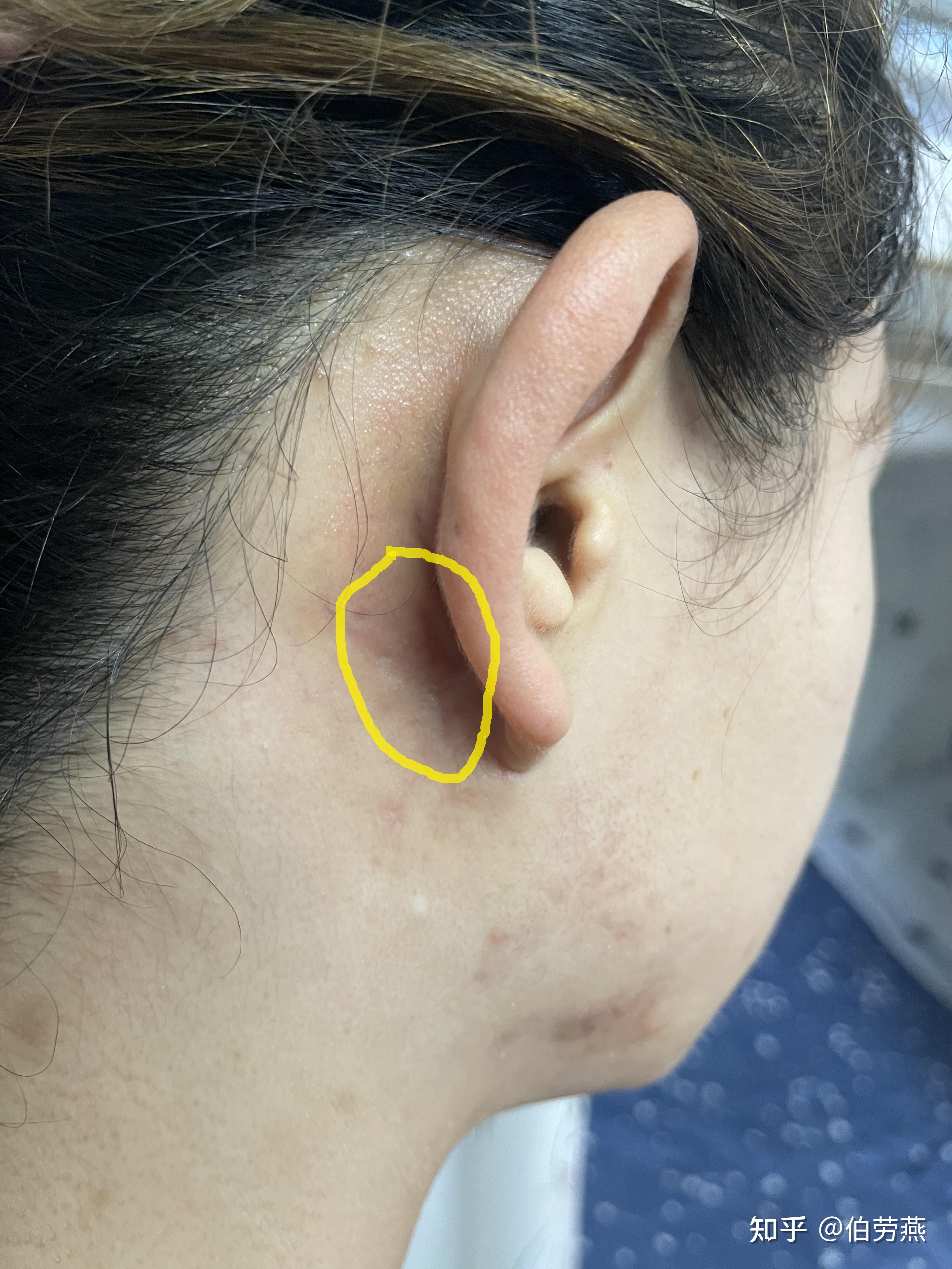 耳洞瘢痕疙瘩增生手术切除记录1 - 知乎