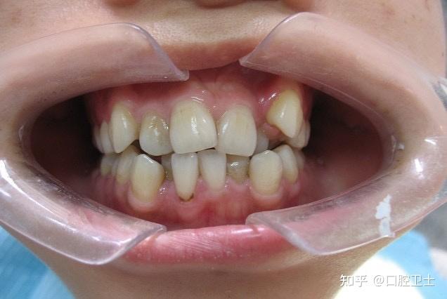 正畸黑三角问题