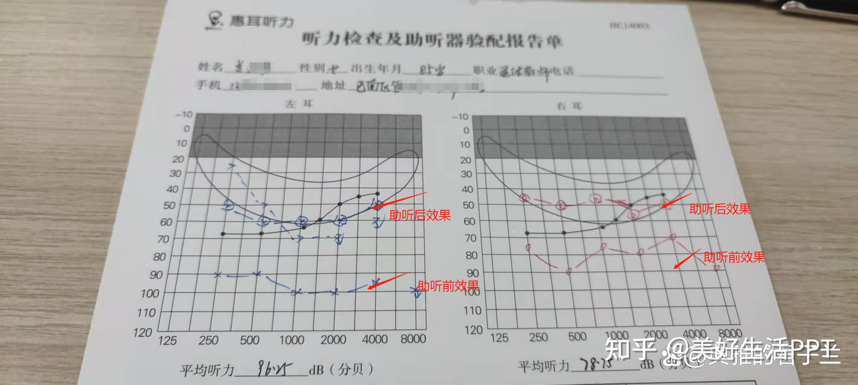 临床表现为高频听力下降,言语识别率降低,脑干诱发电位的潜伏期延长等