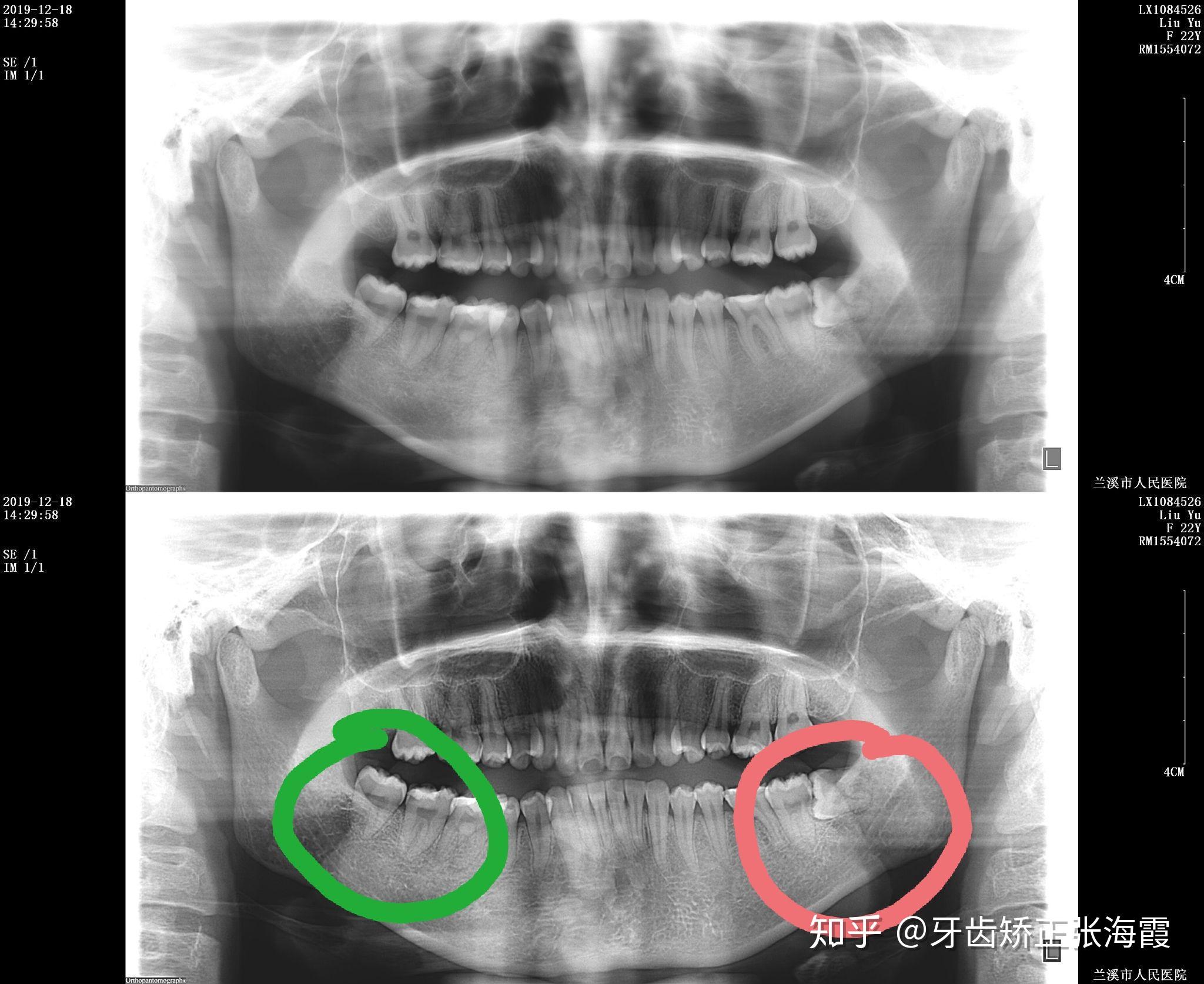 怎么看口腔全景片