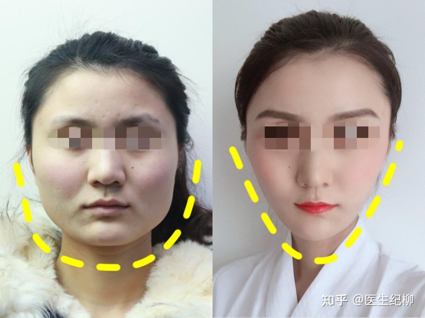 27岁“塌鼻子”女孩奔赴北京，做完鼻整形后5个月，真人案例告诉你这些“弯路”不要走！ - 知乎
