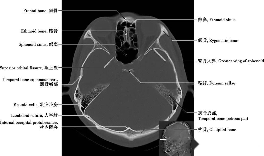 详细标注版！颅脑CT正常解剖图谱 - 知乎