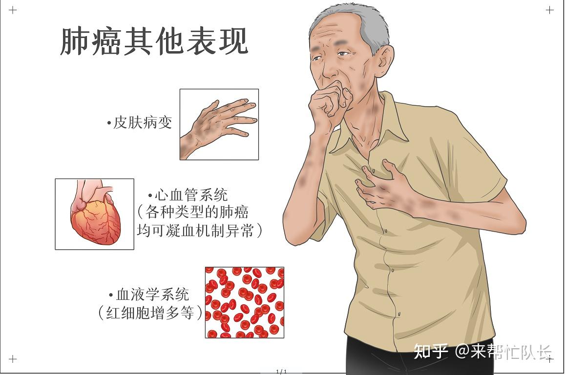 肺癌早期症状能治好吗图片