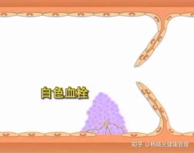 GIF高清动图,带你揭秘血栓形成全过程! - 知乎