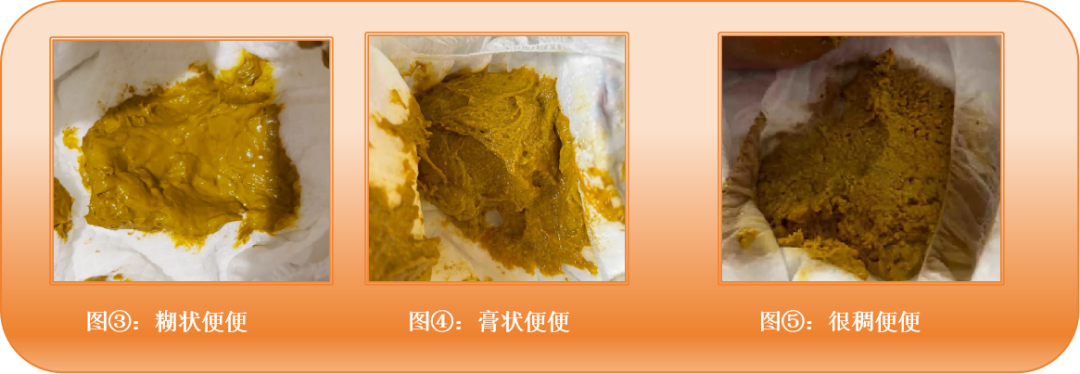 上千位宝妈留言800+真实便便图！超90%异常！如何看懂自家宝宝便便？只需这3步！ - 知乎