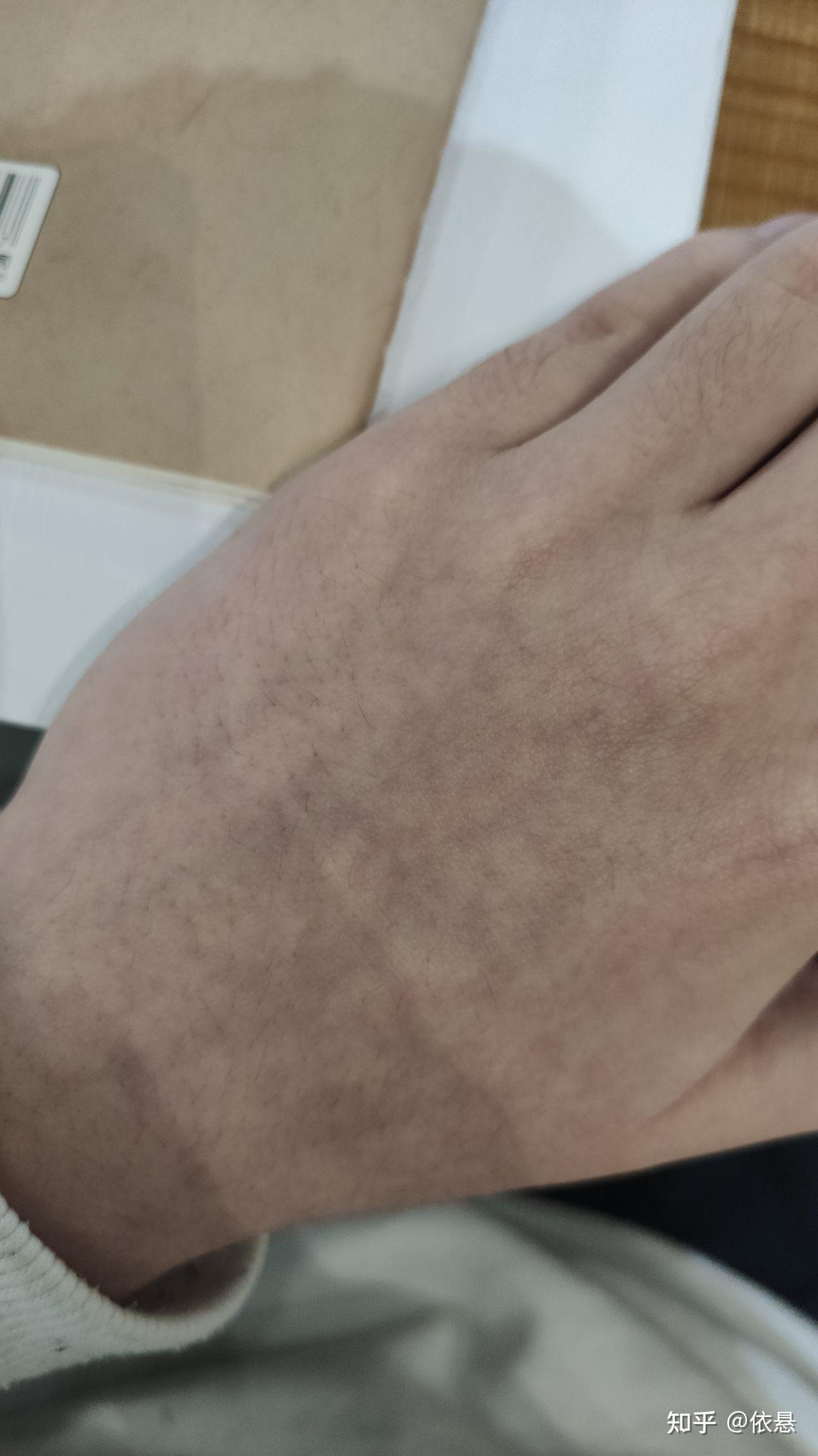 请问天冷时,手心手背都发乌发紫是为什么,是身体有什么问题吗?