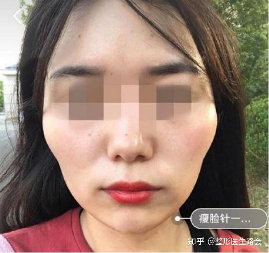 瘦脸针是针对咬肌过于发达的问题,这位求美者本就比较瘦,颧骨较高