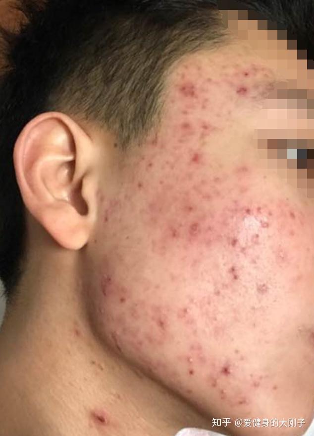 男生脸上痘痘多的你们出门吗
