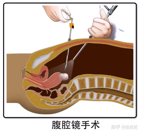 腹腔镜子宫肌瘤手术是怎样的感受?