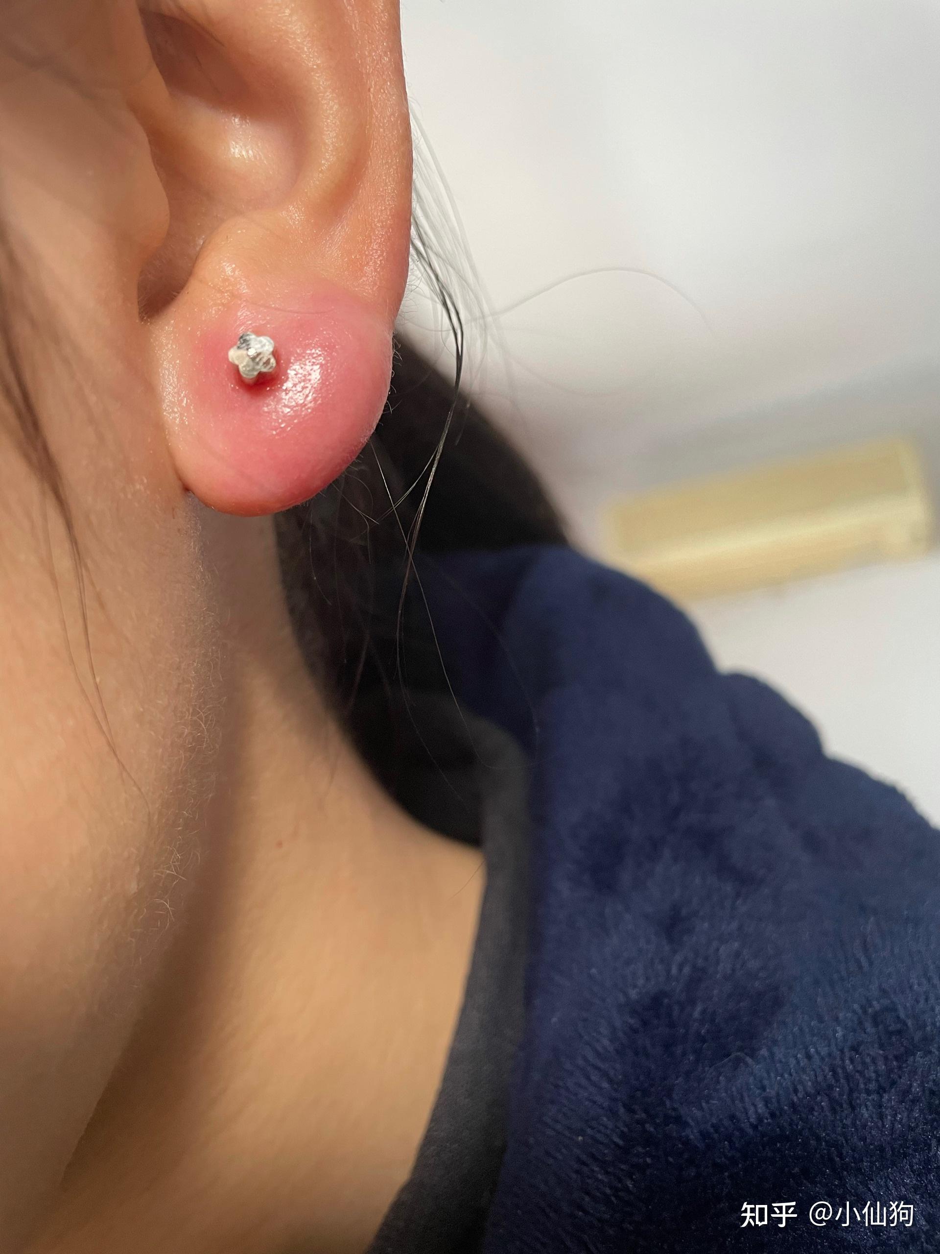 【急】打耳洞不到一个月,昨天不小心扯到耳钉了,今天肿的很厉害,还