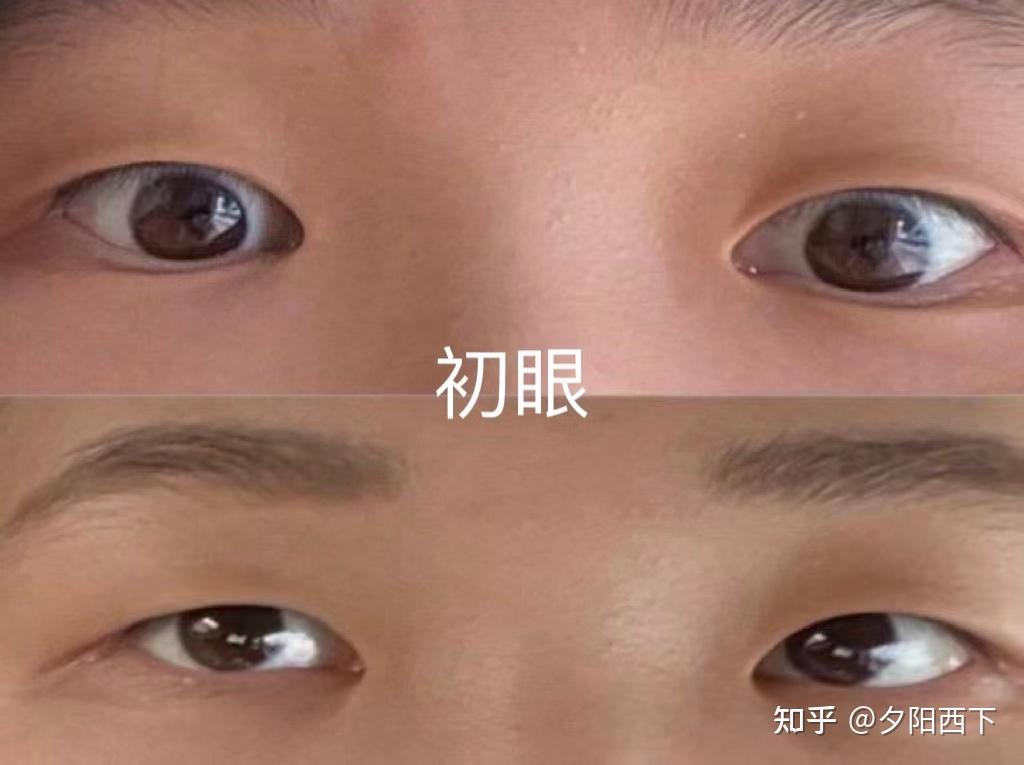 初眼基础不好,眼裂短,眼距宽.越来越妈生